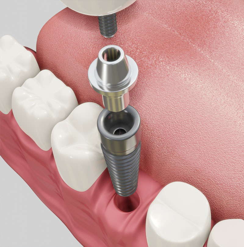 What Is Oral and Maxillofacial Surgery 02