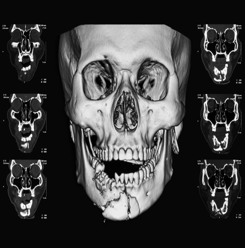 What Is Oral and Maxillofacial Surgery 03