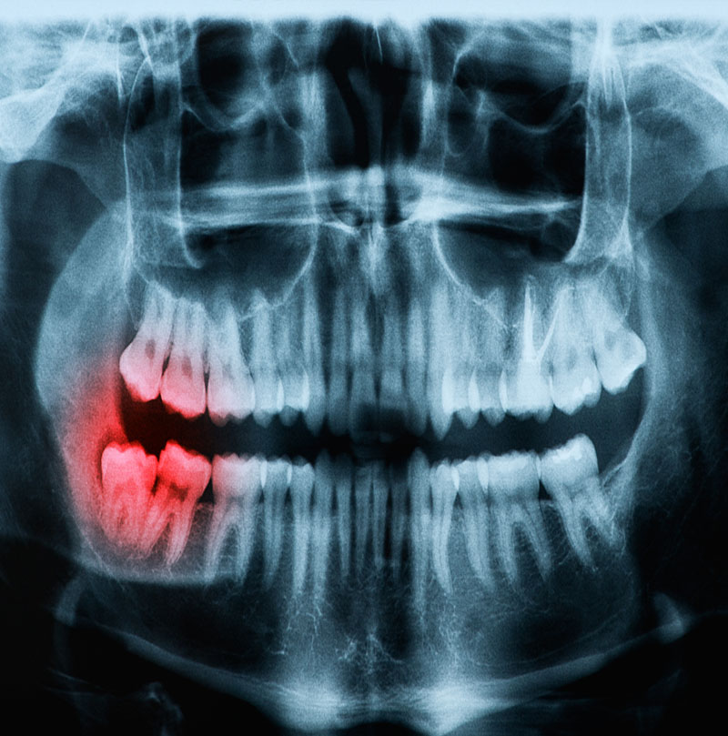 What Is Oral and Maxillofacial Surgery